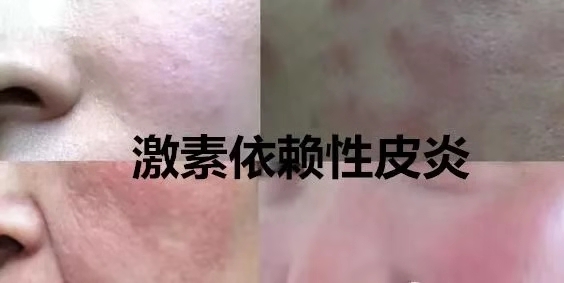 激素脸.jpg