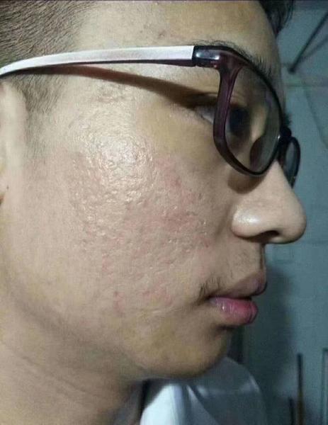 痘痘使用后.jpg